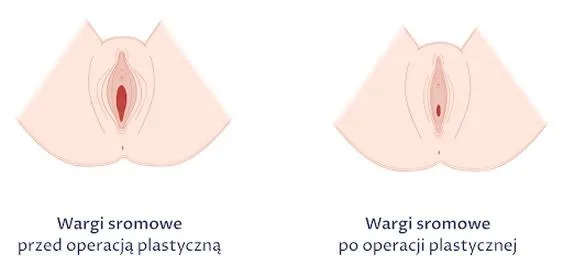 Jak zmienia się wygląd sromu po porodzie: co warto wiedzieć?