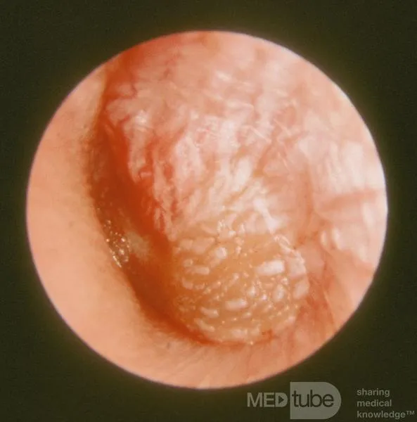 Diagnoza zapalenia ucha