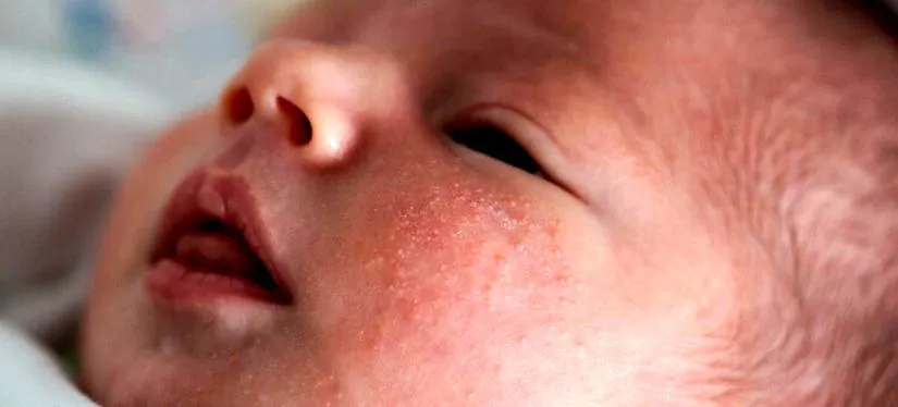 Leczenie potówek u dzieci