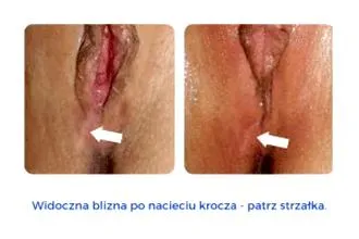 Metody leczenia blizn