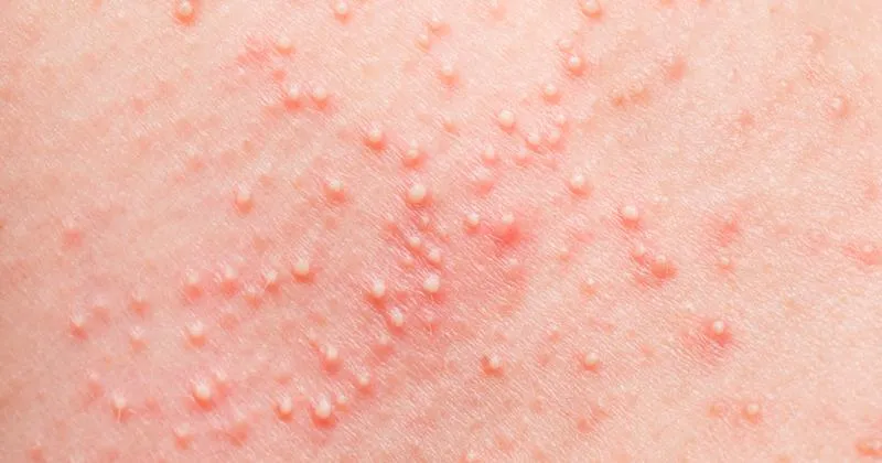 Metody leczenia potówek