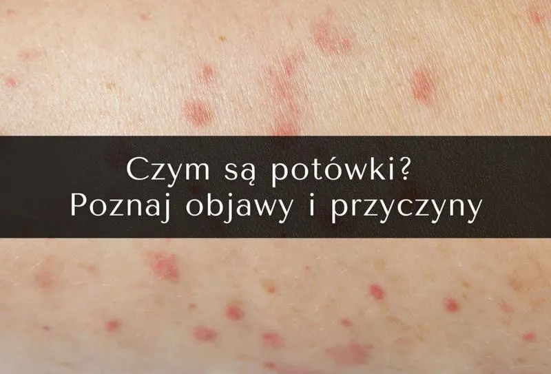 Objawy potówek u dzieci