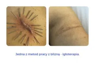 Pielęgnacja blizn