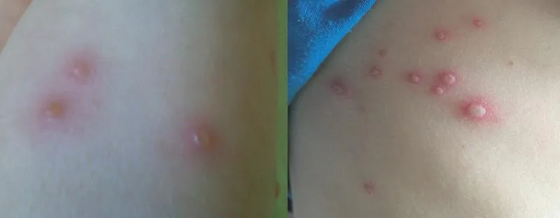 Powikłania związane z ospą wietrzną