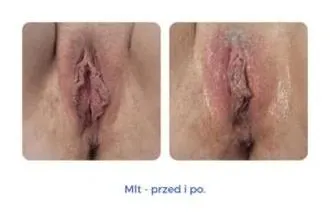 Regeneracja po porodzie