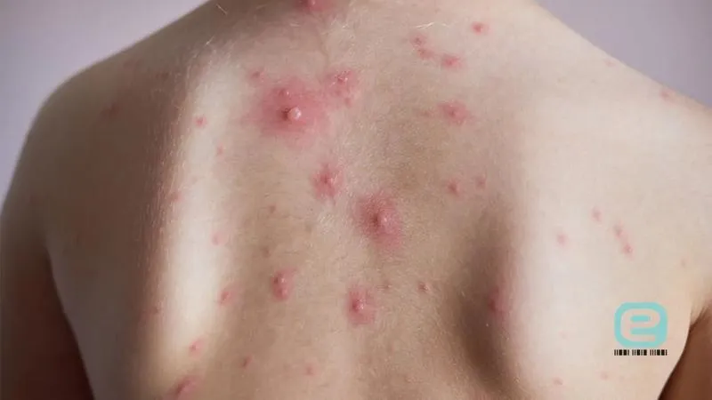 Skuteczne metody łagodzenia swędzenia