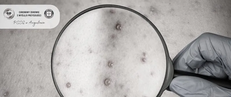 Szczepionka przeciwko ospie wietrznej