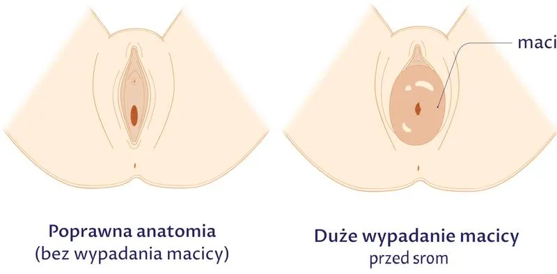 Wygląd sromu po porodzie