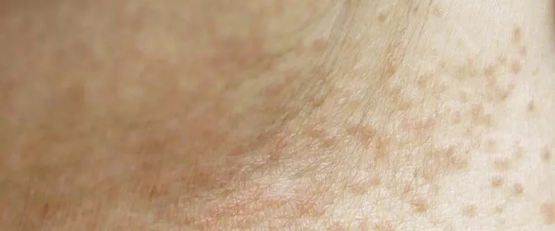 Zapobieganie potówkom u dzieci